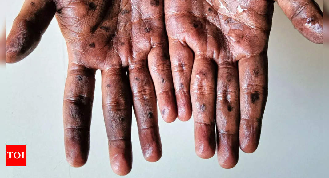 Monkeypox in India: Govt issues advisory to states and UTs on preventing Mpox spread | India News