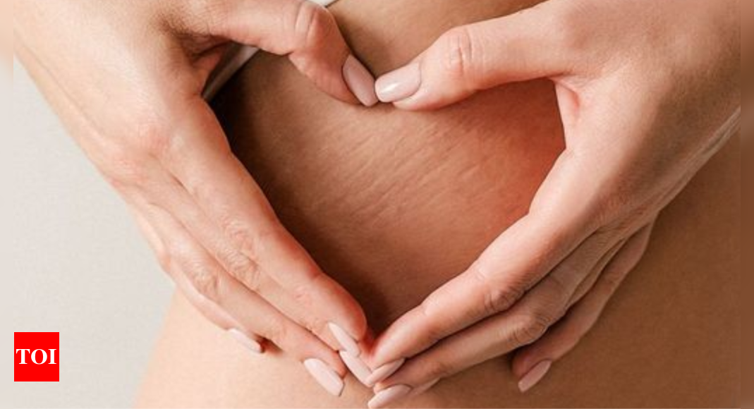 Stretch Marks Home Remedies: Best home remedies to get rid of stretch marks |